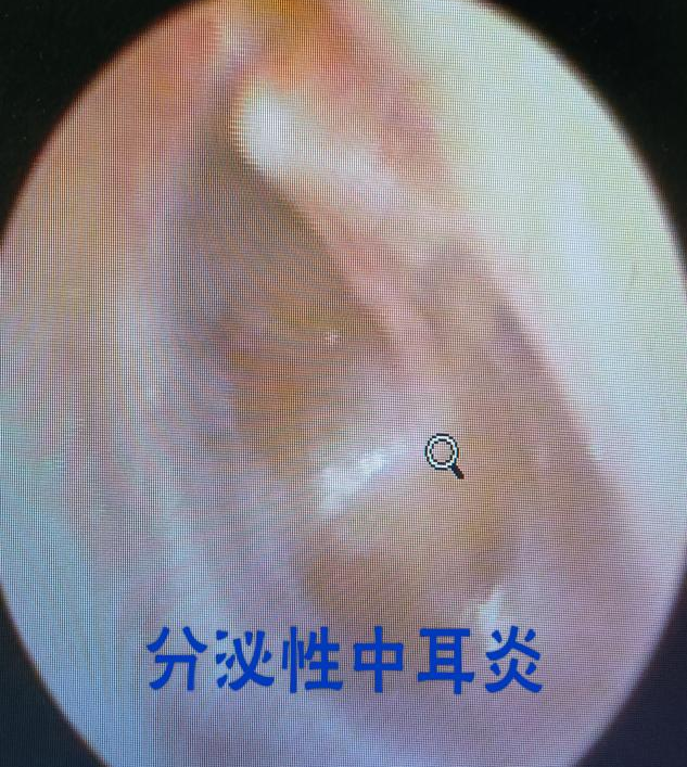 耳鼻喉内窥镜检查是检查什么耳鼻喉内窥镜可以检查哪些疾病？_https://www.jmylbn.com_新闻资讯_第9张