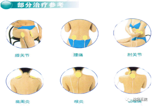 中频电疗怎么收费【健康科普堂】最常用的理疗原来是它——中频电疗_https://www.jmylbn.com_新闻资讯_第9张