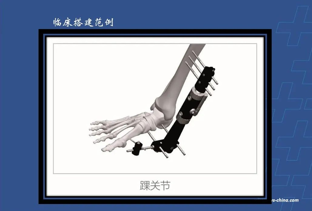为什么会有单关节器械【临床用械】骨科用外固定支架的来源、应用介绍_https://www.jmylbn.com_新闻资讯_第6张