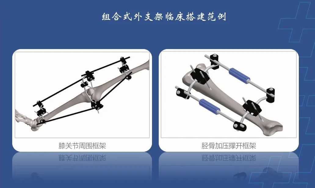 为什么会有单关节器械【临床用械】骨科用外固定支架的来源、应用介绍_https://www.jmylbn.com_新闻资讯_第16张