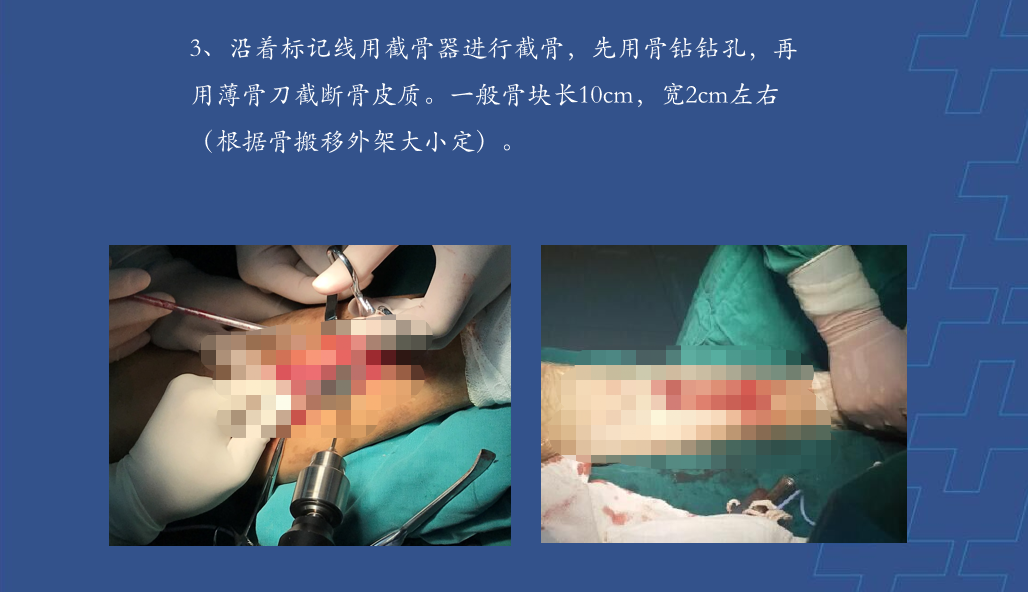 为什么会有单关节器械【临床用械】骨科用外固定支架的来源、应用介绍_https://www.jmylbn.com_新闻资讯_第23张