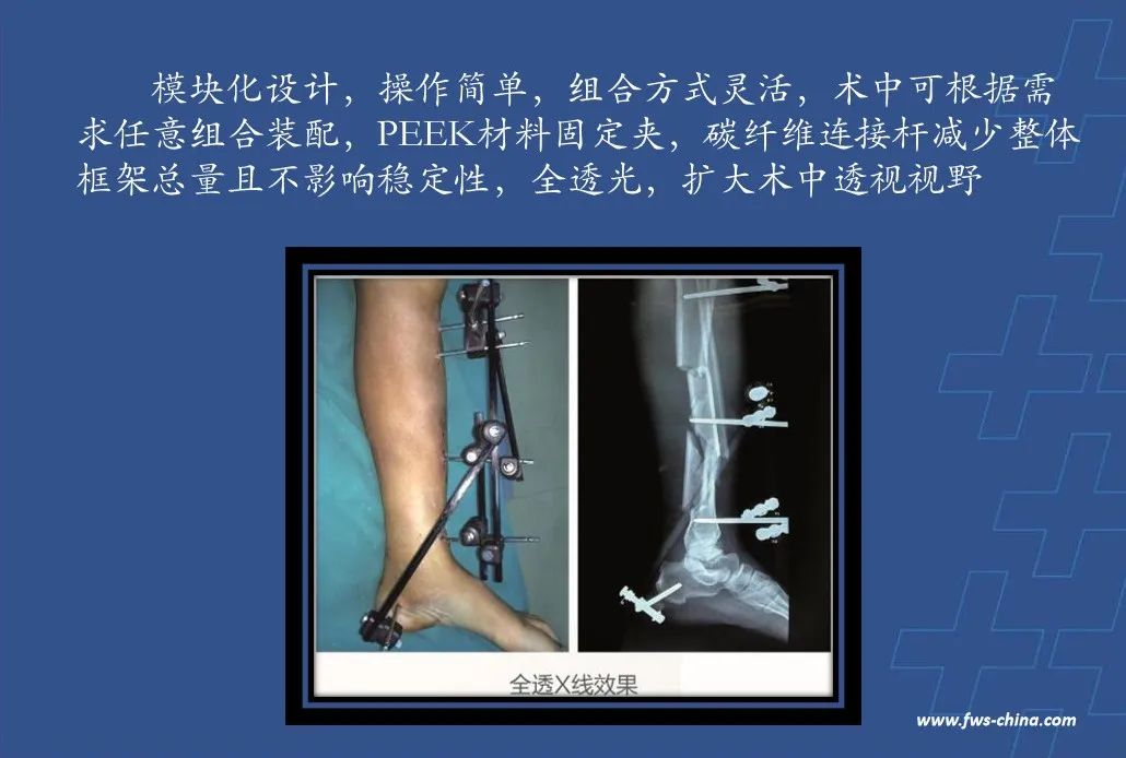 为什么会有单关节器械【临床用械】骨科用外固定支架的来源、应用介绍_https://www.jmylbn.com_新闻资讯_第12张