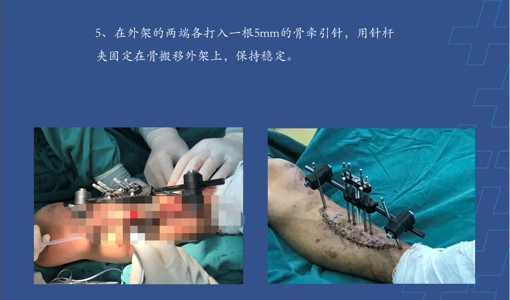 为什么会有单关节器械【临床用械】骨科用外固定支架的来源、应用介绍_https://www.jmylbn.com_新闻资讯_第25张