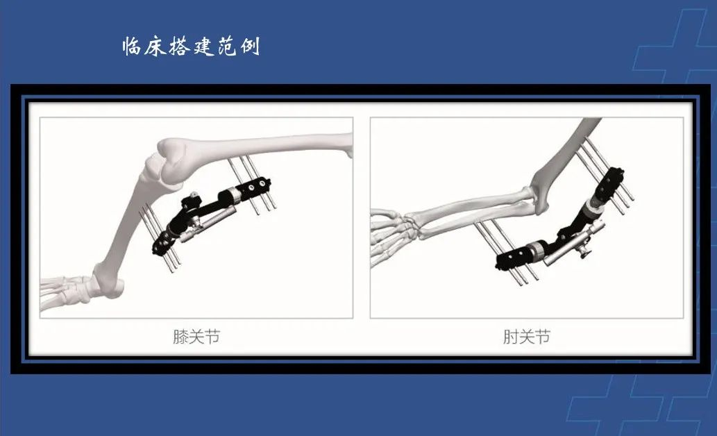 为什么会有单关节器械【临床用械】骨科用外固定支架的来源、应用介绍_https://www.jmylbn.com_新闻资讯_第8张