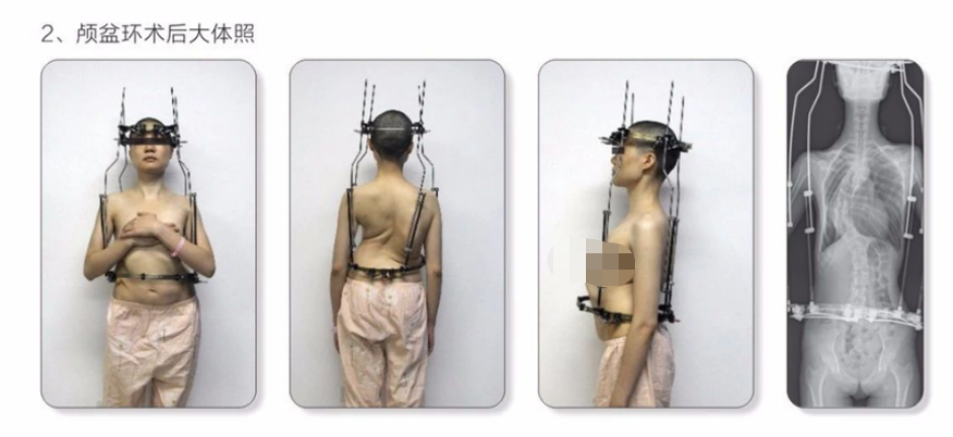 为什么会有单关节器械【临床用械】骨科用外固定支架的来源、应用介绍_https://www.jmylbn.com_新闻资讯_第31张