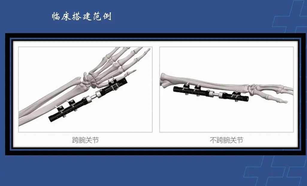 为什么会有单关节器械【临床用械】骨科用外固定支架的来源、应用介绍_https://www.jmylbn.com_新闻资讯_第4张