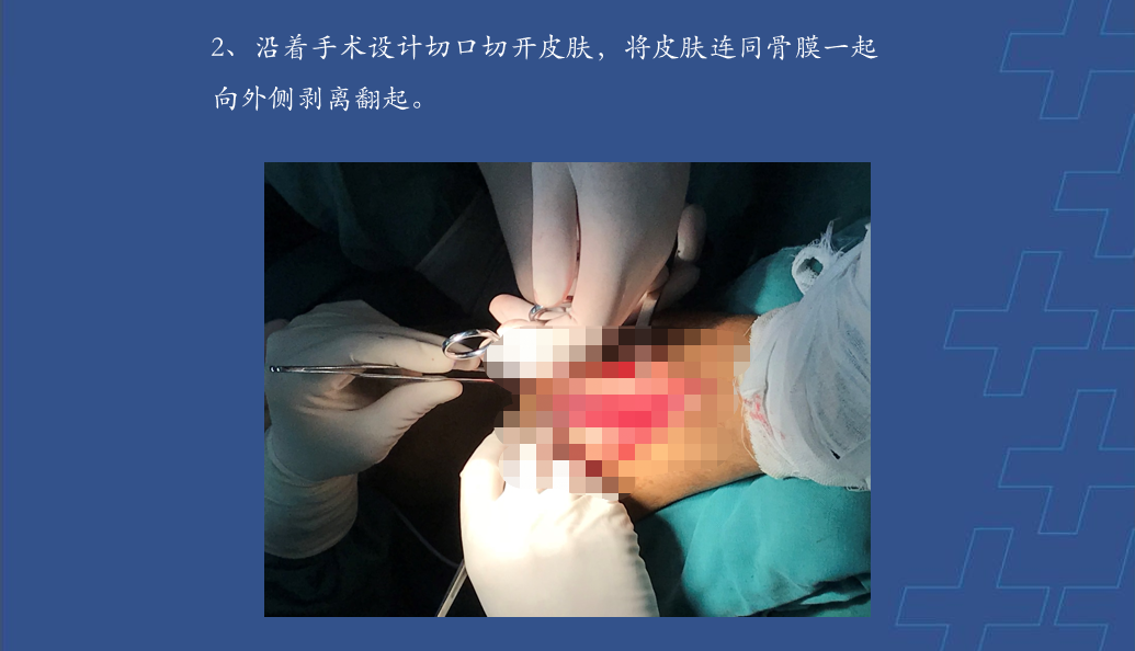 为什么会有单关节器械【临床用械】骨科用外固定支架的来源、应用介绍_https://www.jmylbn.com_新闻资讯_第22张