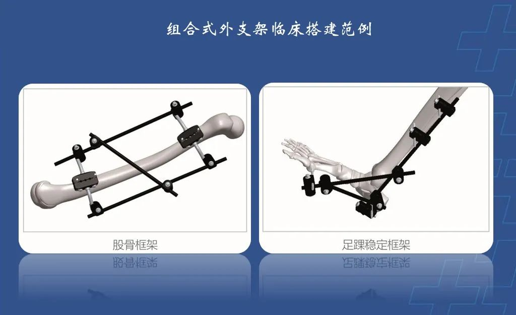 为什么会有单关节器械【临床用械】骨科用外固定支架的来源、应用介绍_https://www.jmylbn.com_新闻资讯_第15张