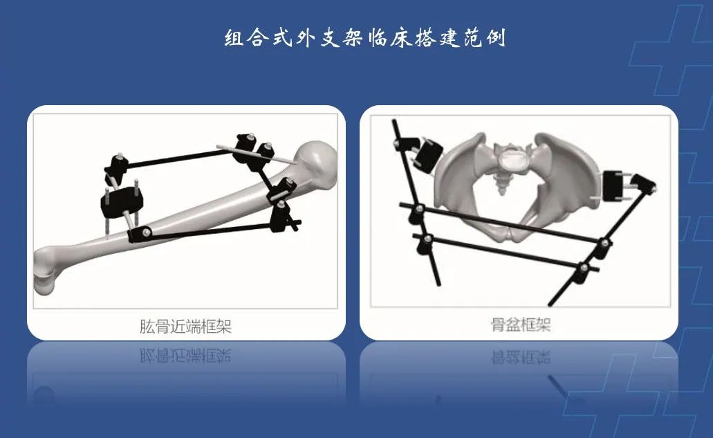 为什么会有单关节器械【临床用械】骨科用外固定支架的来源、应用介绍_https://www.jmylbn.com_新闻资讯_第14张
