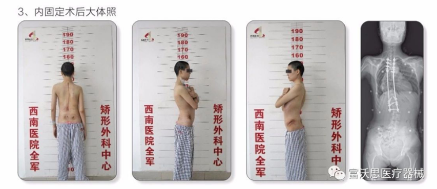 为什么会有单关节器械【临床用械】骨科用外固定支架的来源、应用介绍_https://www.jmylbn.com_新闻资讯_第32张