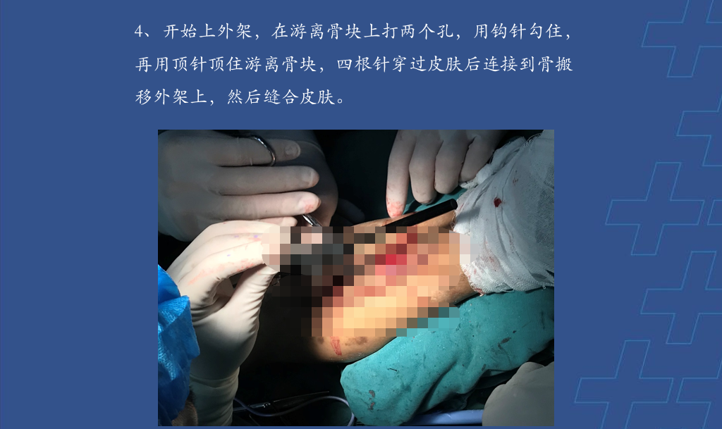 为什么会有单关节器械【临床用械】骨科用外固定支架的来源、应用介绍_https://www.jmylbn.com_新闻资讯_第24张