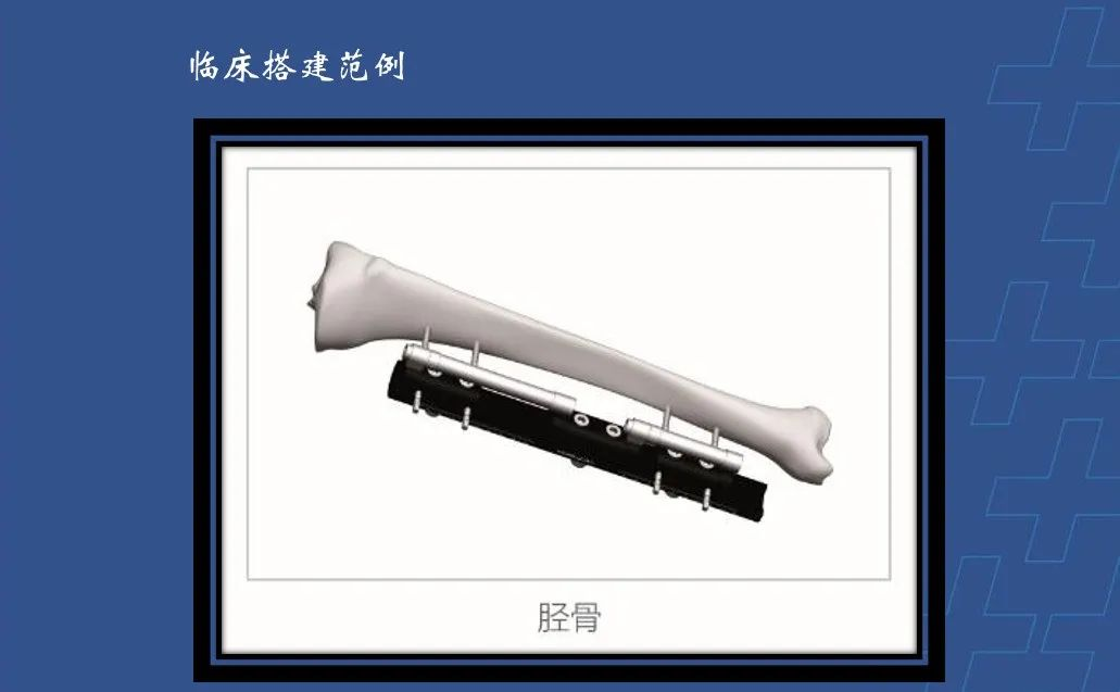 为什么会有单关节器械【临床用械】骨科用外固定支架的来源、应用介绍_https://www.jmylbn.com_新闻资讯_第10张