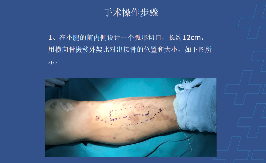 为什么会有单关节器械【临床用械】骨科用外固定支架的来源、应用介绍_https://www.jmylbn.com_新闻资讯_第21张