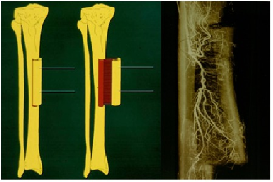 为什么会有单关节器械【临床用械】骨科用外固定支架的来源、应用介绍_https://www.jmylbn.com_新闻资讯_第18张