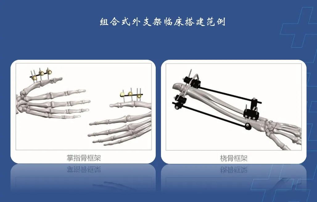 为什么会有单关节器械【临床用械】骨科用外固定支架的来源、应用介绍_https://www.jmylbn.com_新闻资讯_第13张