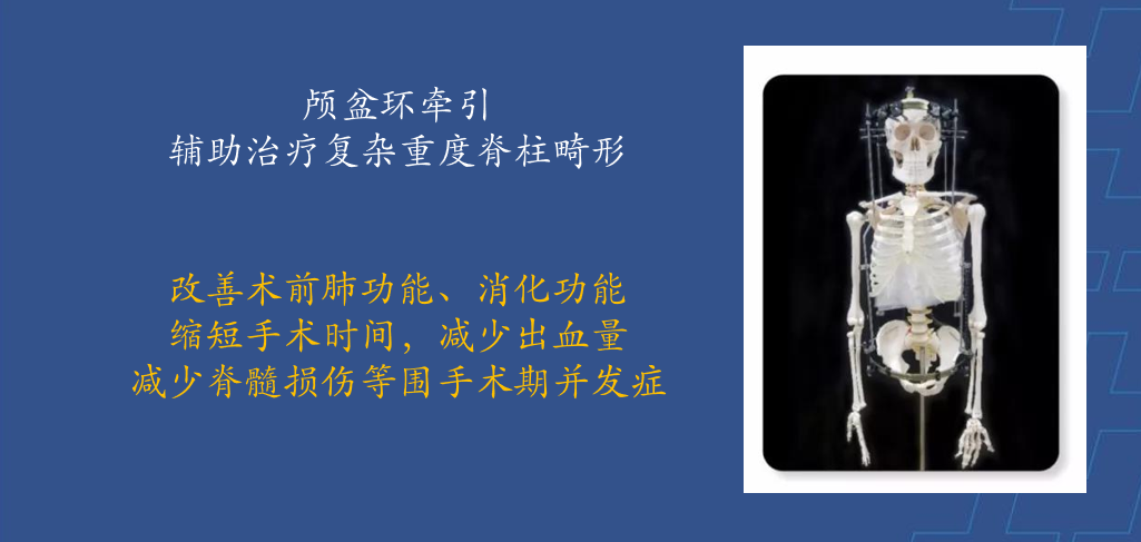 为什么会有单关节器械【临床用械】骨科用外固定支架的来源、应用介绍_https://www.jmylbn.com_新闻资讯_第29张