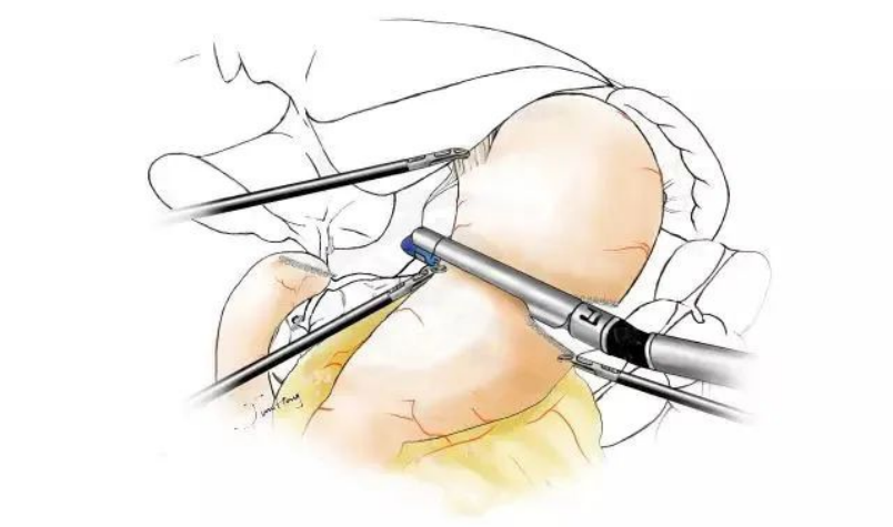吻合器怎么用【临床用械】一次性使用腔镜切割吻合器（途龙II型）操作要点！！！_https://www.jmylbn.com_新闻资讯_第13张