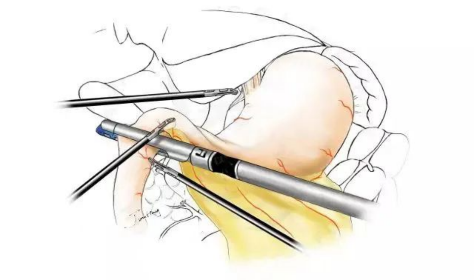 吻合器怎么用【临床用械】一次性使用腔镜切割吻合器（途龙II型）操作要点！！！_https://www.jmylbn.com_新闻资讯_第12张