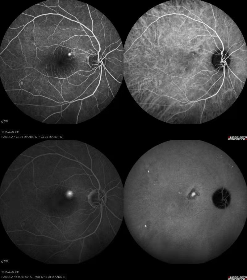 眼底激光机有什么牌子【高视光太EasyRet病例品鉴】巧手医中浆_https://www.jmylbn.com_新闻资讯_第4张