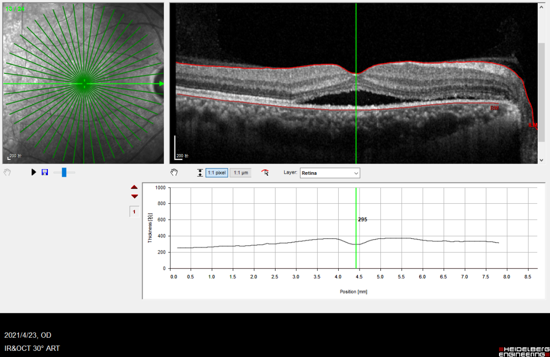 眼底激光机有什么牌子【高视光太EasyRet病例品鉴】巧手医中浆_https://www.jmylbn.com_新闻资讯_第2张