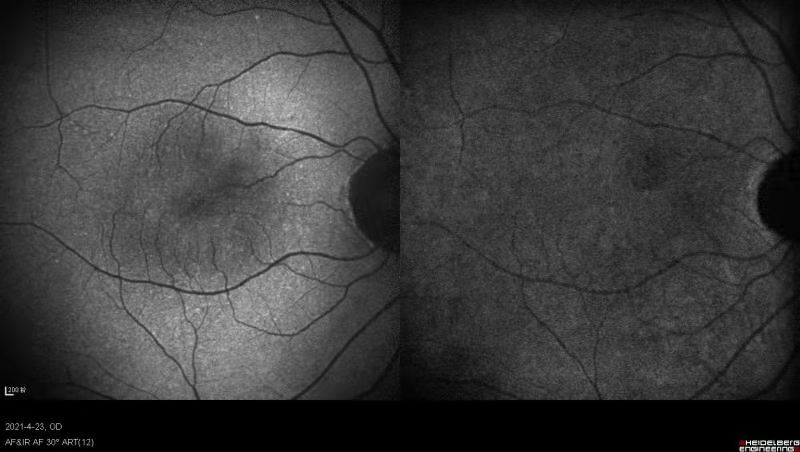 眼底激光机有什么牌子【高视光太EasyRet病例品鉴】巧手医中浆_https://www.jmylbn.com_新闻资讯_第3张