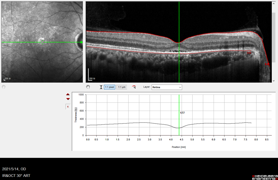 眼底激光机有什么牌子【高视光太EasyRet病例品鉴】巧手医中浆_https://www.jmylbn.com_新闻资讯_第8张