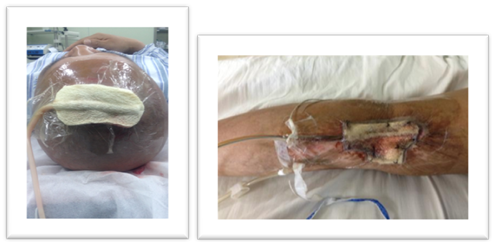 VSD怎么更换引流瓶「治疗」浅谈VSD技术(负压封闭引流术) 王钧 山西省中西医结合医院肾病一科_https://www.jmylbn.com_新闻资讯_第3张