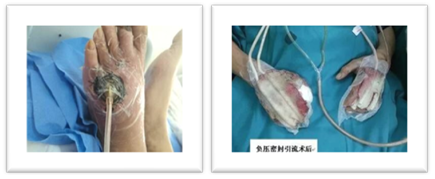 VSD怎么更换引流瓶「治疗」浅谈VSD技术(负压封闭引流术) 王钧 山西省中西医结合医院肾病一科_https://www.jmylbn.com_新闻资讯_第2张