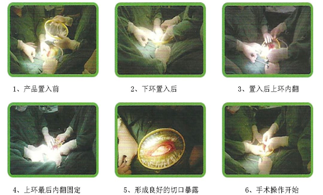 为什么不用切口保护套无锡东峰怡和切口保护套_https://www.jmylbn.com_新闻资讯_第8张