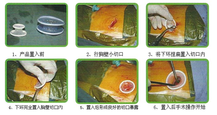 为什么不用切口保护套无锡东峰怡和切口保护套_https://www.jmylbn.com_新闻资讯_第11张