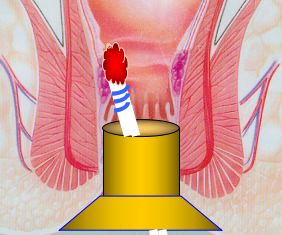 套扎器怎么用无锡东峰怡和 一次性使用肛肠套扎器使用简介_https://www.jmylbn.com_新闻资讯_第14张