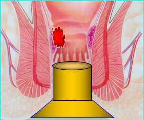 套扎器怎么用无锡东峰怡和 一次性使用肛肠套扎器使用简介_https://www.jmylbn.com_新闻资讯_第13张