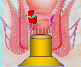 套扎器怎么用无锡东峰怡和 一次性使用肛肠套扎器使用简介_https://www.jmylbn.com_新闻资讯_第15张