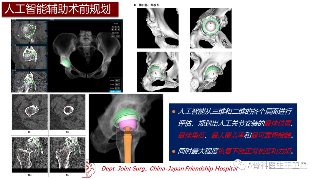 病例:ai輔助術前規劃全髖關節置換(2020-h002))_人工髖關節置換術