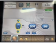 白内障注吸器怎么使用白内障超声乳化手术I／A注吸皮质、抛光及人工晶体植入技术_https://www.jmylbn.com_新闻资讯_第1张