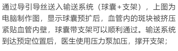 【干货】支架介入手术图文直播