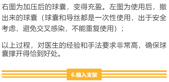 【干货】支架介入手术图文直播