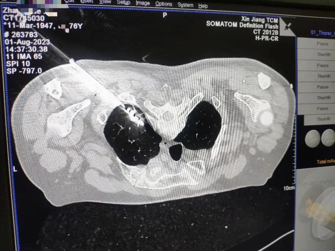 微波针是什么【新闻快递】呼吸一科：肺癌微波消融术——小细针解决大问题_https://www.jmylbn.com_新闻资讯_第9张