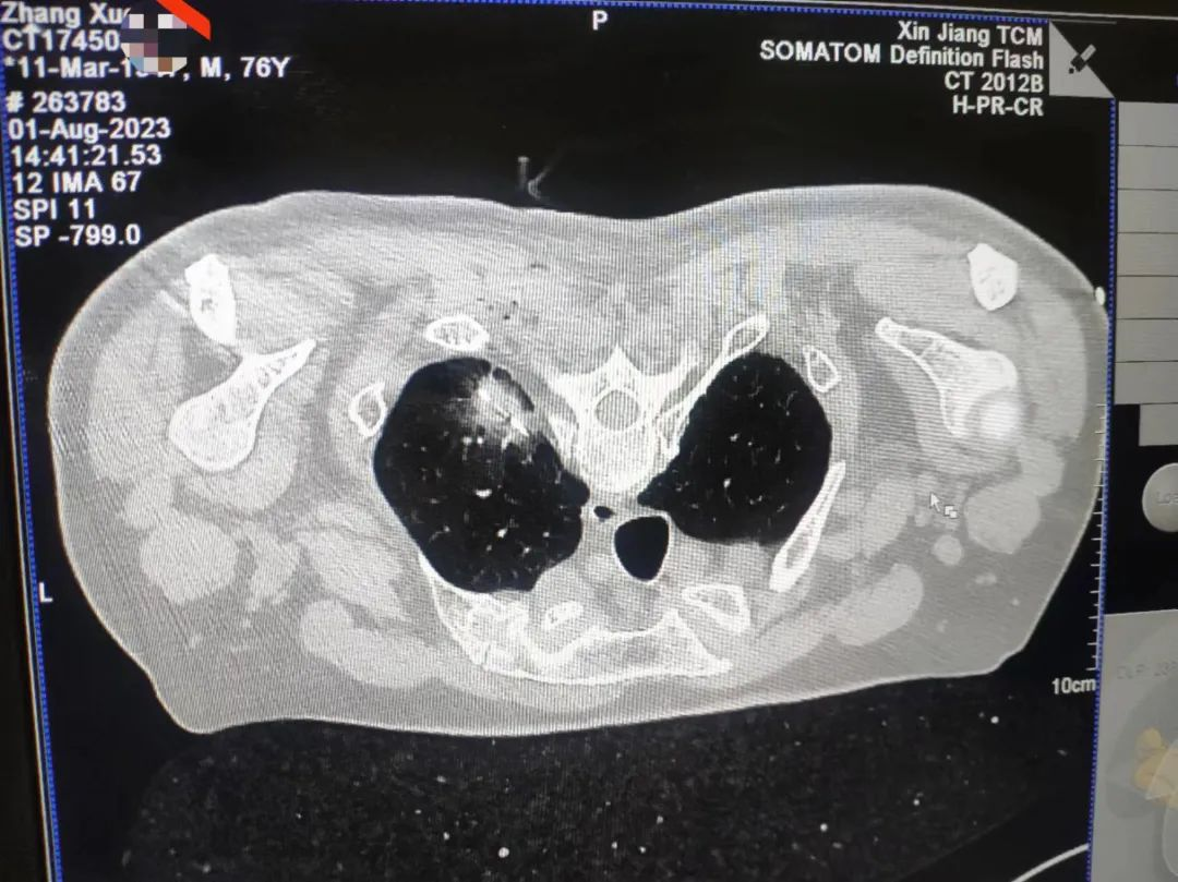 微波针是什么【新闻快递】呼吸一科：肺癌微波消融术——小细针解决大问题_https://www.jmylbn.com_新闻资讯_第8张