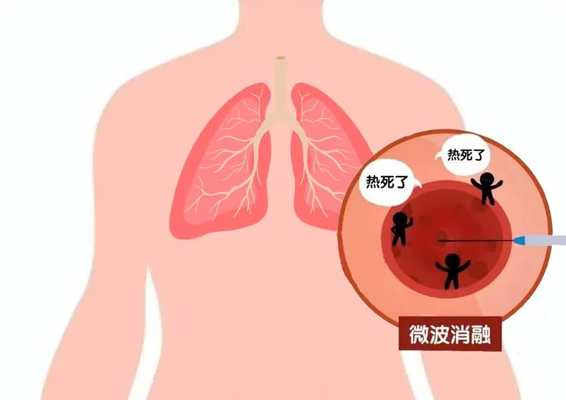 微波针是什么【新闻快递】呼吸一科：肺癌微波消融术——小细针解决大问题_https://www.jmylbn.com_新闻资讯_第4张