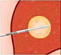 微波针是什么【新闻快递】呼吸一科：肺癌微波消融术——小细针解决大问题_https://www.jmylbn.com_新闻资讯_第3张