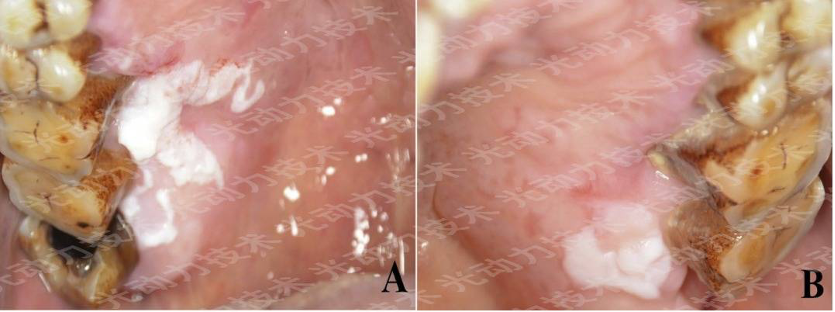 避光针是治疗什么的行医笔记｜梅花针辅助氨基酮戊酸光动力治疗高龄高危腭部白斑_https://www.jmylbn.com_新闻资讯_第5张