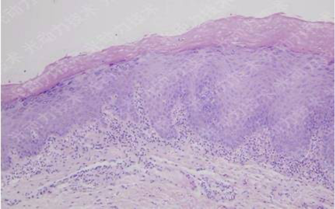避光针是治疗什么的行医笔记｜梅花针辅助氨基酮戊酸光动力治疗高龄高危腭部白斑_https://www.jmylbn.com_新闻资讯_第4张