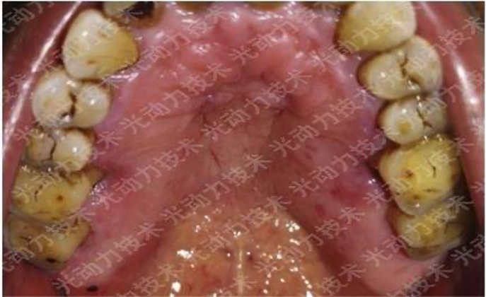 避光针是治疗什么的行医笔记｜梅花针辅助氨基酮戊酸光动力治疗高龄高危腭部白斑_https://www.jmylbn.com_新闻资讯_第9张