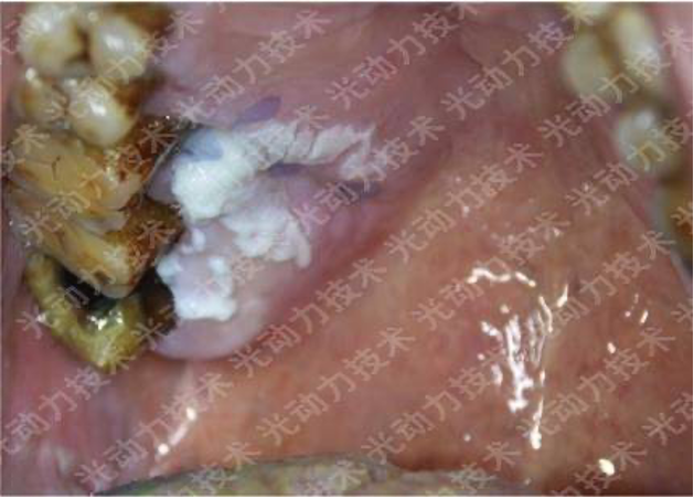 避光针是治疗什么的行医笔记｜梅花针辅助氨基酮戊酸光动力治疗高龄高危腭部白斑_https://www.jmylbn.com_新闻资讯_第7张