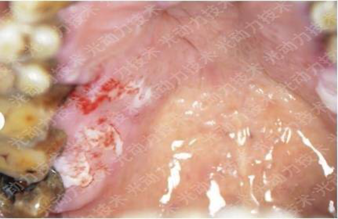 避光针是治疗什么的行医笔记｜梅花针辅助氨基酮戊酸光动力治疗高龄高危腭部白斑_https://www.jmylbn.com_新闻资讯_第8张