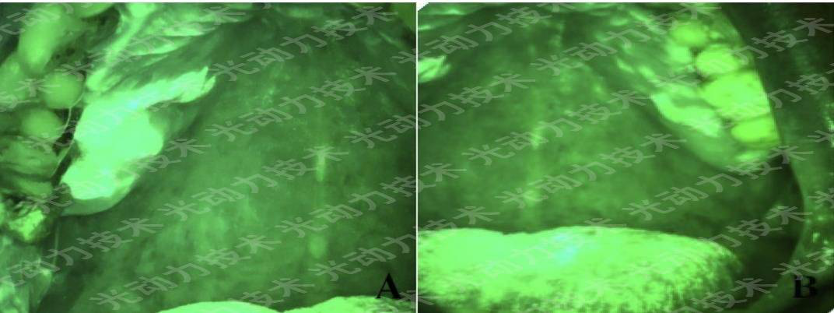 避光针是治疗什么的行医笔记｜梅花针辅助氨基酮戊酸光动力治疗高龄高危腭部白斑_https://www.jmylbn.com_新闻资讯_第6张