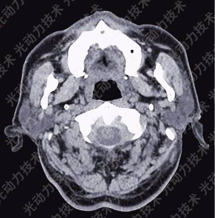 避光针是治疗什么的行医笔记｜梅花针辅助氨基酮戊酸光动力治疗高龄高危腭部白斑_https://www.jmylbn.com_新闻资讯_第3张