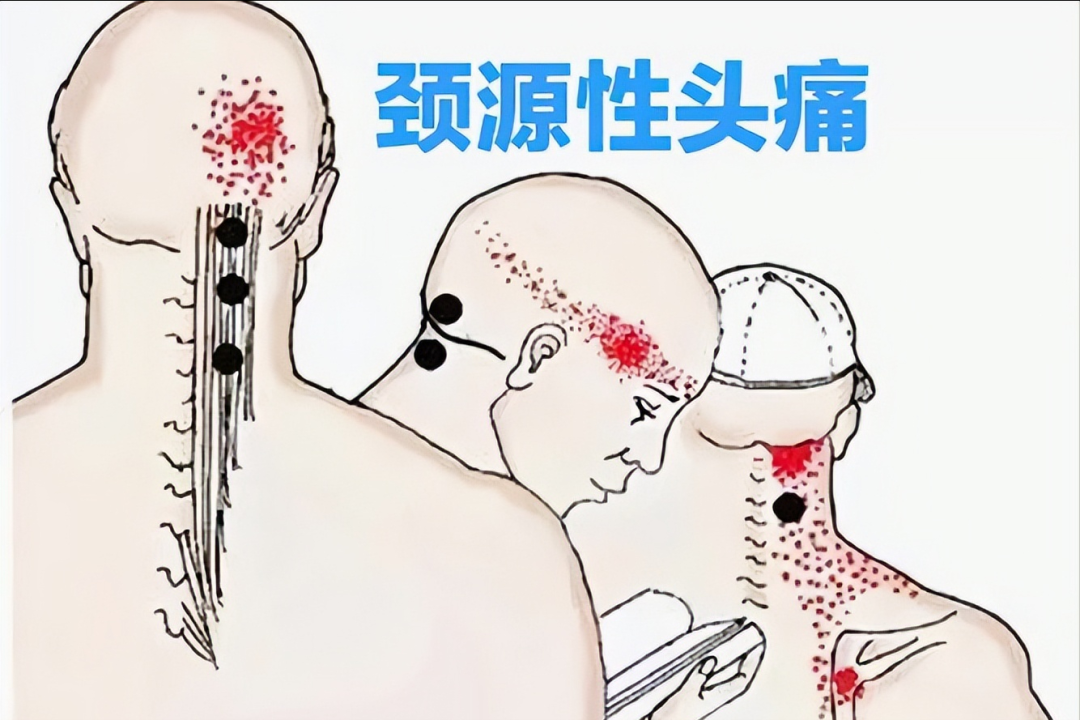 枕后4条神经：枕大、枕小、枕下及第三枕神经