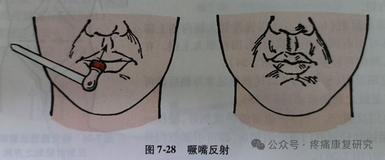 叩诊锤的怎么用康复必备：41个常见的神经反射检查_https://www.jmylbn.com_新闻资讯_第27张